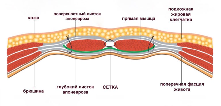 Пупочная грыжа с сальником